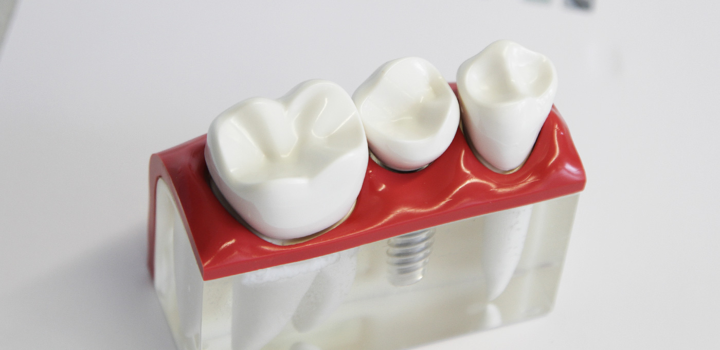 Implanty sposobem na zębowe ubytki